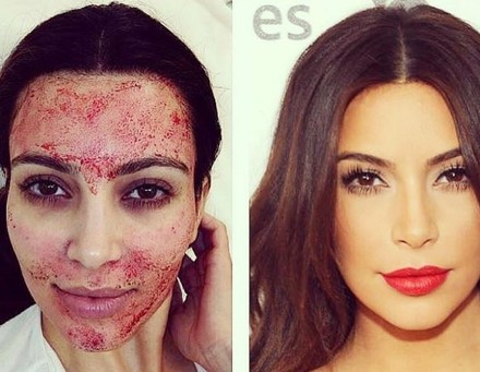 Kim Kardashian während und nach ihrem „Vampire-Facelift“. (Foto: © pi42unapologeticbeautycare/instagram)